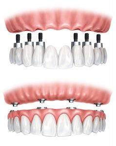 3 Denture Care Tips that Will Keep Your Smile Looking Great - South Calgary Dentures - Denture and Implant Clinic Calgary