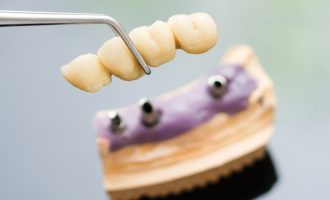 3 Ways You Can Replace Missing Teeth - South Calgary Dentures - Denture and Implant Clinic Calgary