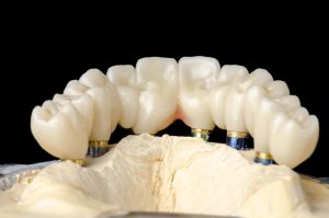 Anchoring a Denture With Dental Implants - South Calgary Dentures - Dentures and Implants Calgary